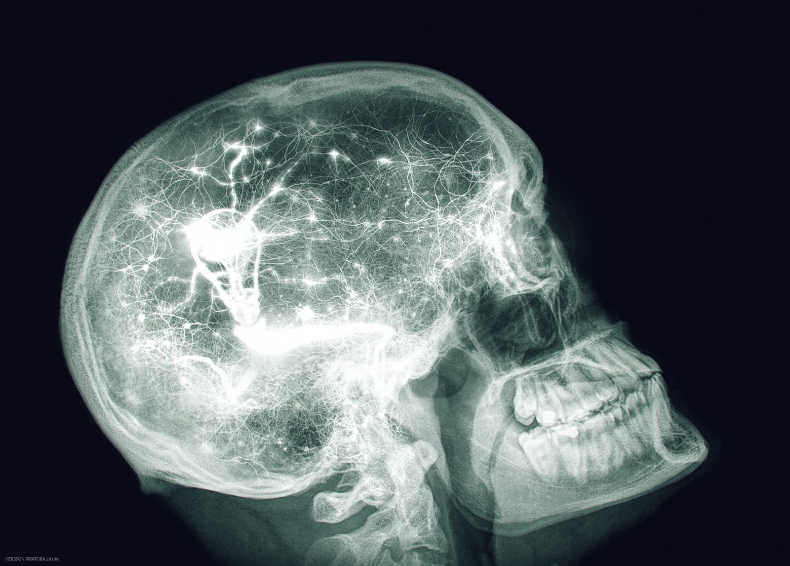 X-ray of skull